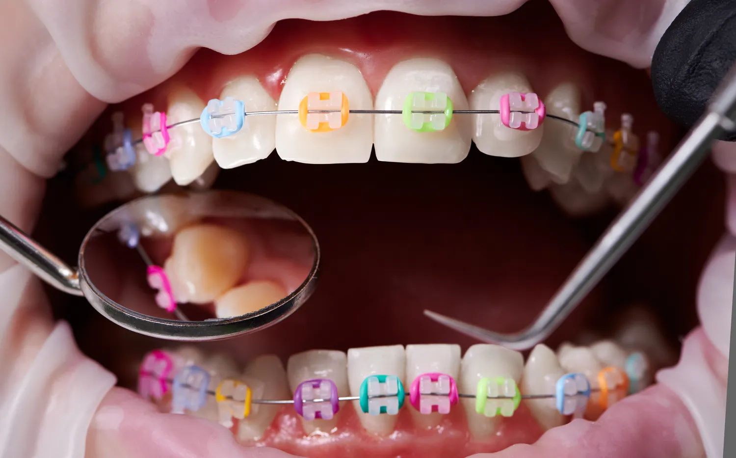 Jak się przygotować do wszczepienia implantów zębów?