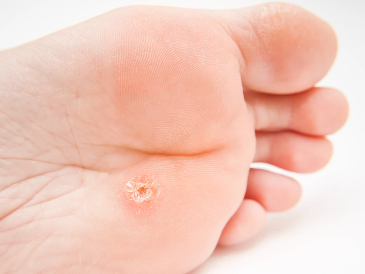 Pedicure leczniczy - co na ten temat wiedzieć trzeba?